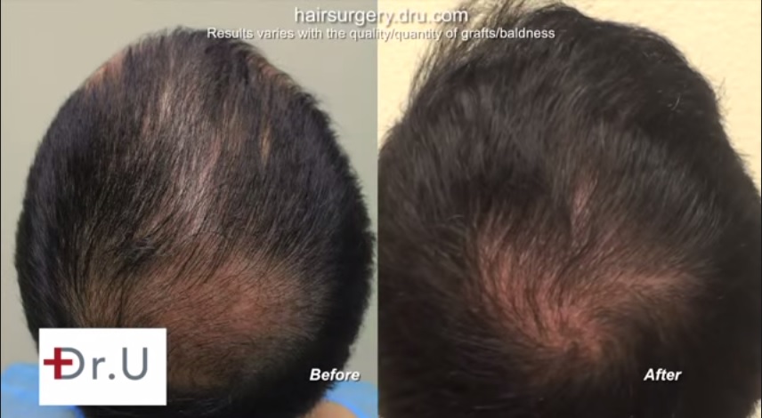 Crown Hair Transplant|Examples