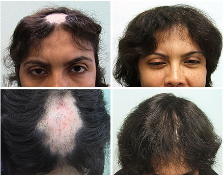 Female Patient With Hair Loss Due to Lupus