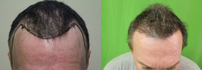 Hair Transplantation General FAQ