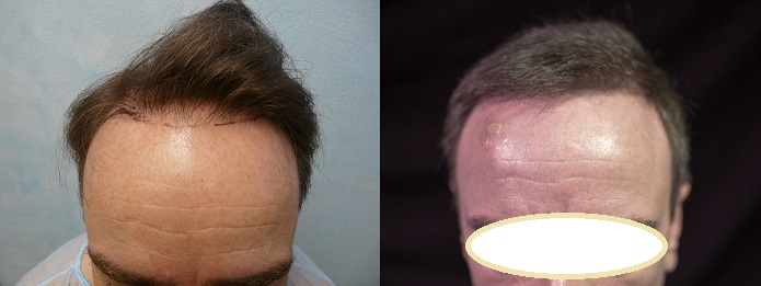 Best Hair Transplant Doctor In The World - Patient Challenges