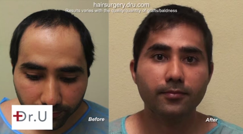 Hairline & Temple Restoration| Patient's Before & After Photos