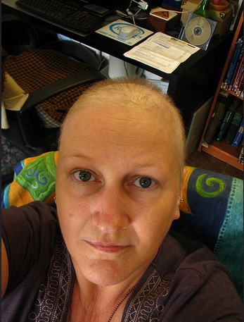 Chemotherapy Hair Loss : A cancer patient after treatments 
