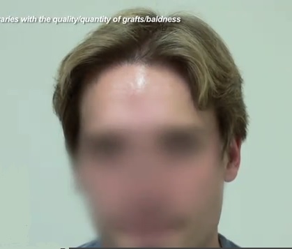 Patient's Final Results After His FUE Hairline Restoration