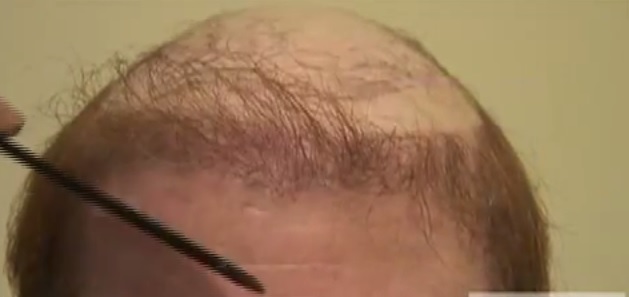 Hair Loss From Hair Piece - Repair Surgery Case