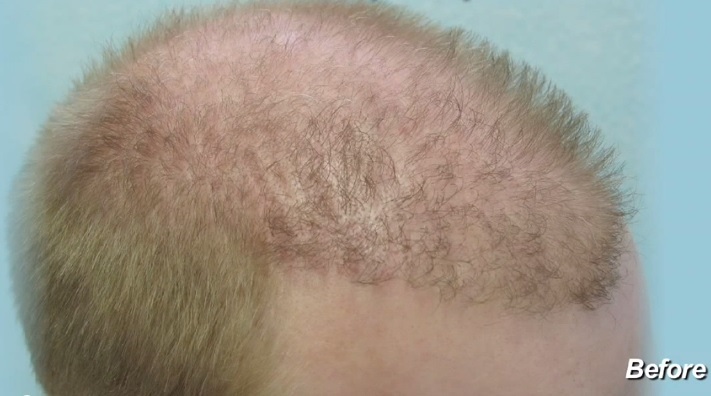 Image of Young Hair Repair Patient Before Surgery