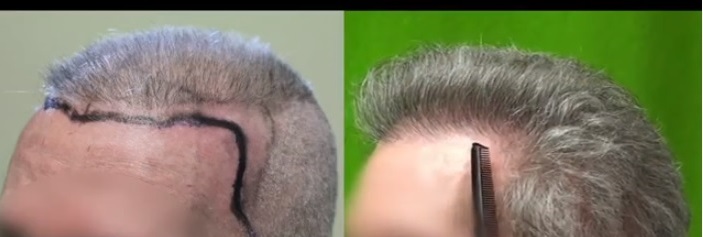 best hair restoration surgeon| extreme patient challenges