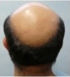 androgenic alopecia hair loss statistics
