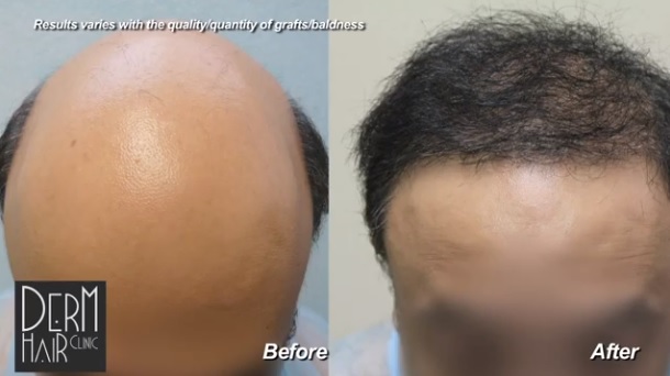 Front view of hair transplant results for severe baldness
