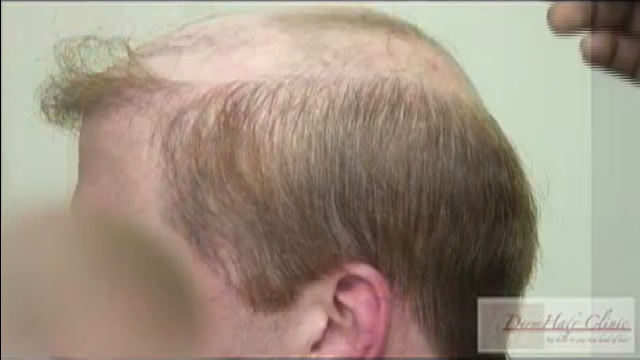 Hair Transplant Repair Patient Before Body Hair Transplant