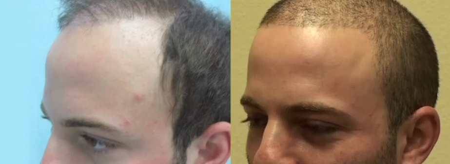 Beard & Head Hair | Hybrid Hair Transplant Surgery. UGraft Advanced FUE Head Hair Transplantation 