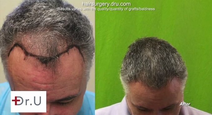 FUE Mature Hairline Restoration|Before & After Surgery