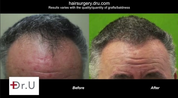 FUE For Mature Hairline & Temples|Patient's Results