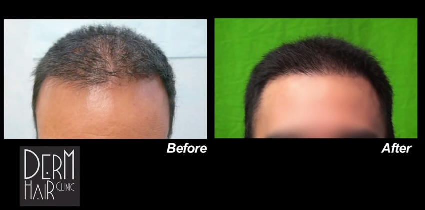 Fue hairline repair, Repair of Hairline Graft Angles