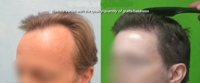 Only Hair Transplant Works for Hairline Recession