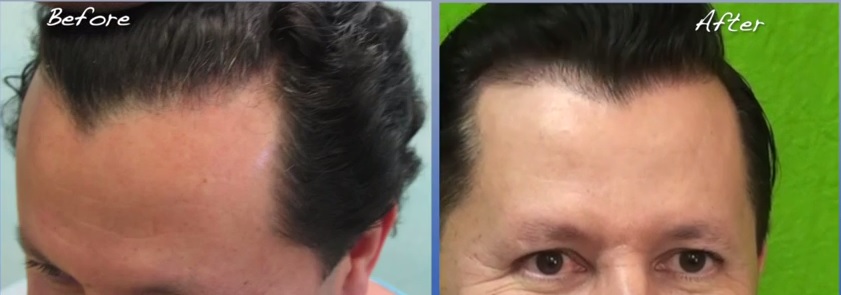 Hair transplant concerns include whether or not your hairline would look soft and natural