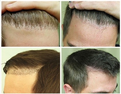 Hairline Plugs Repair Using UGraft FUE with Head, Nape and Beard Hair - before and after 