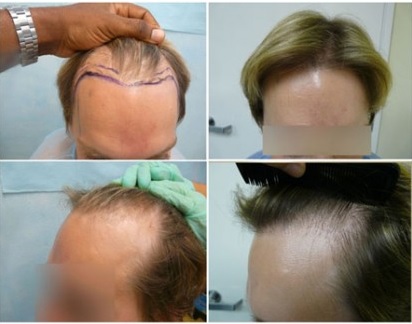 Hairline Recession| FUE Transplant Surgery