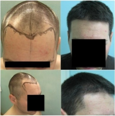 hairline restoration Advanced FUE