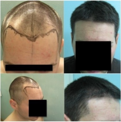 Hair Restoration: You do not have to settle for linear scarring with your hair transplant