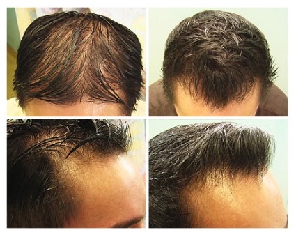 Ethnicity and Hair Loss, before and after UGraft for an asian patient