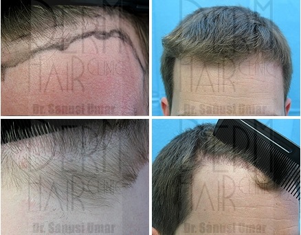 best hair restoration clinic in the world| before and after