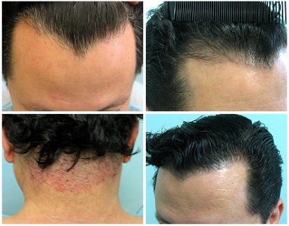 Using Nape Hair by FUE uGraft to Create Natural Hairlines 