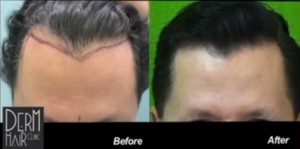 Study on Creation of Natural Hairlines and Temples Using Nape Hair before and after photo