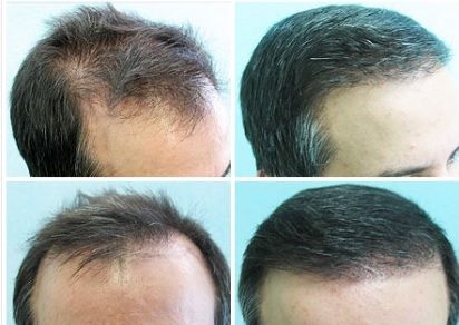 Restoring Hairline With 5000 Graft BHT Surgery