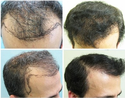 Body Hair Grafts Used For Hairline Transplantation