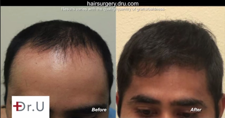 Hairline Transplant| FUE| Close Up