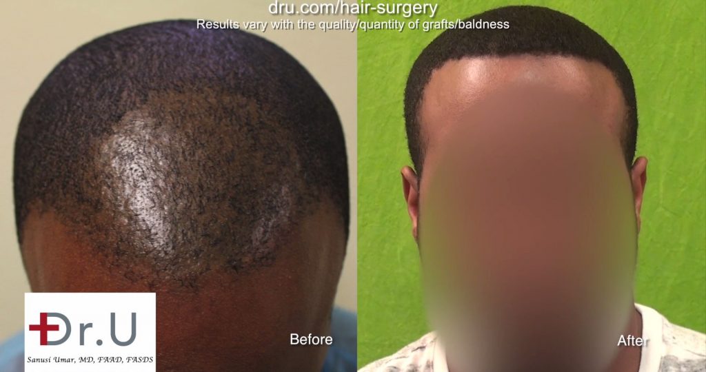 2320 Grafts Used for African American FUE Hair Transplant Repair