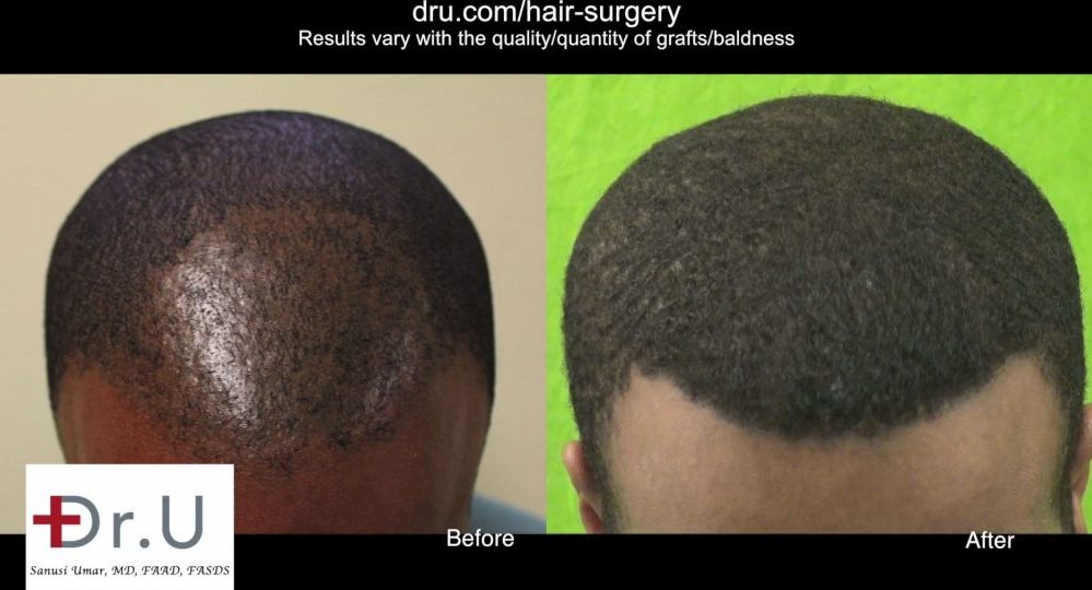 Video Fue Punch For African American Hair Transplant Dr Upunch Curl