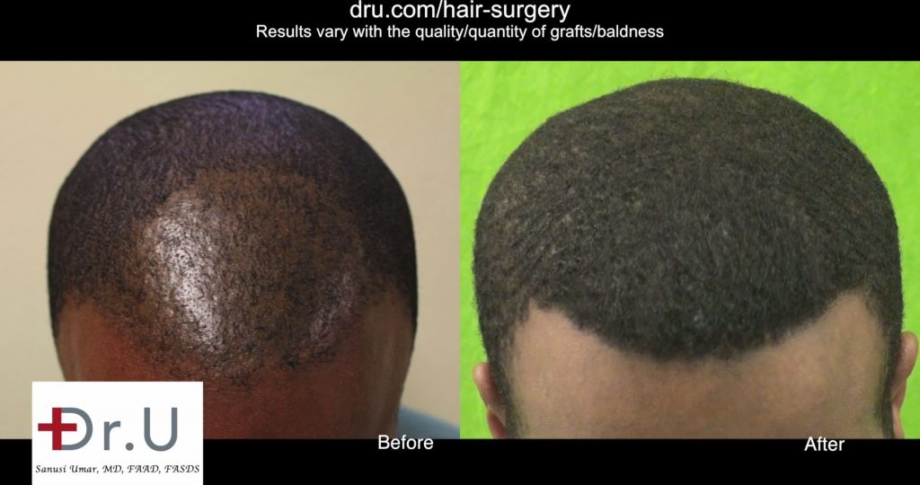 2320 Grafts Used for African American FUE Hair Transplant Repair