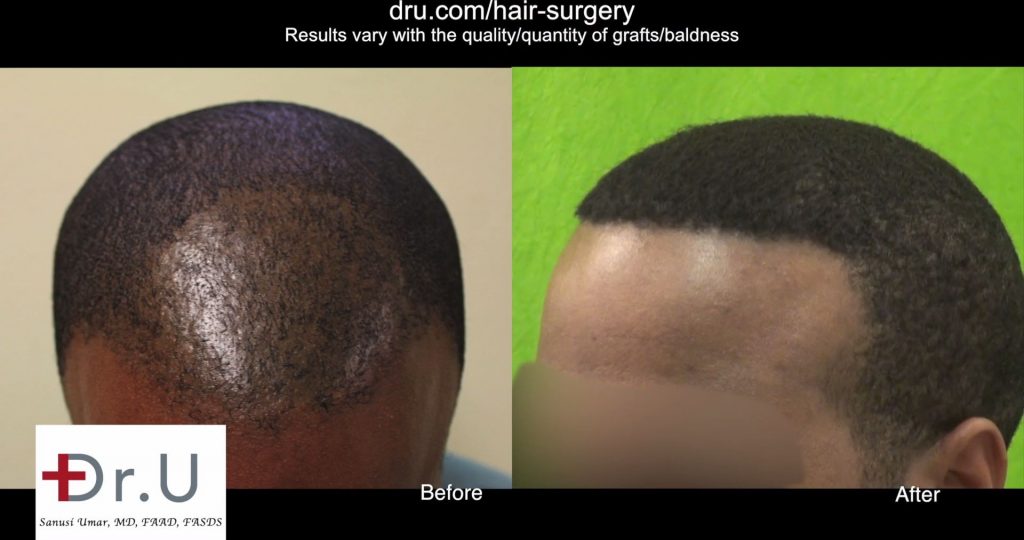 2320 Grafts Used for African American FUE Hair Transplant Repair