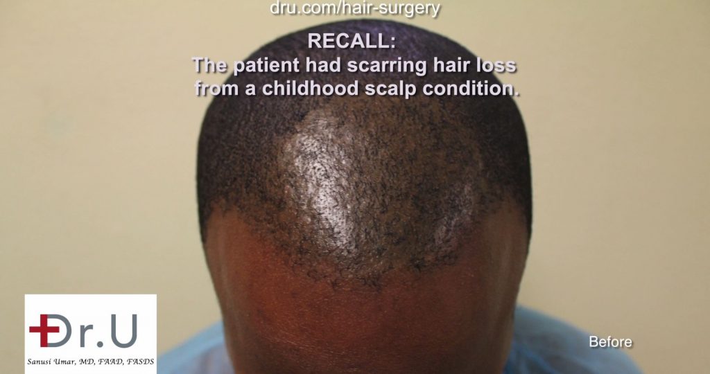 2320 Grafts Used for African American FUE Hair Transplant Repair