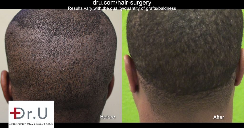 2320 Grafts Used for African American FUE Hair Transplant Repair