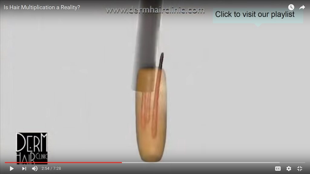 longitudinal follicular splitting from small FUE punch usage leads to extraction of single and thinner hairs