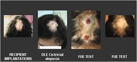 scarring-alopecia Lupus|Hair Transplant With FUE|Patient Photos