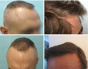 Dr U Hair Transplant Results - DermHair Clinic Los Angeles 310-318-1500