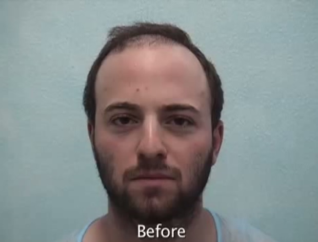 Patient Before His Beard Hair Transplant Surgery