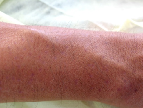 BHT Donor Healing| Redness| Patients With Lighter Skin