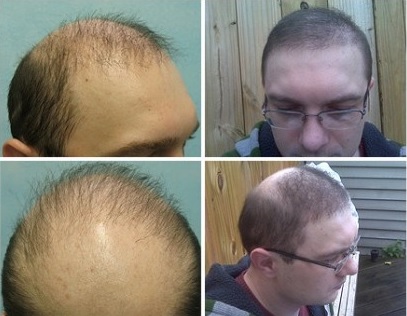 Repairing Poor Hairline Growth With Advanced FUE