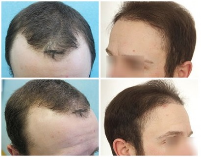 Hairline Restoration With Donor Grafts From Scalp