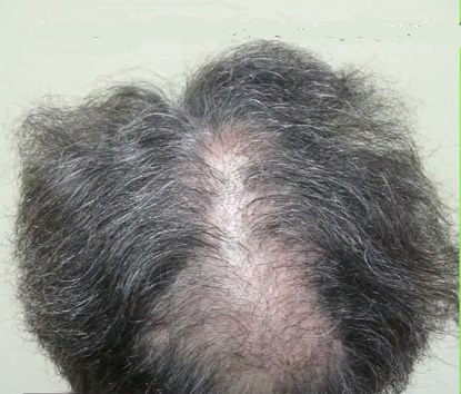 Scalp Reduction and Slot Formation - Hair Restoration Deformity