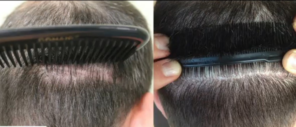 FUE Grafts Conceal Strip Scarring