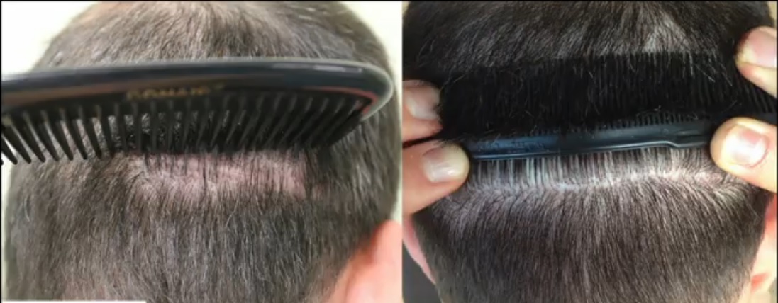 FUE Grafts Conceal Strip Scarring