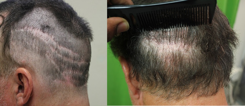 best FUE hair restoration surgeon in the world| hair transplant repair case|strip scarring