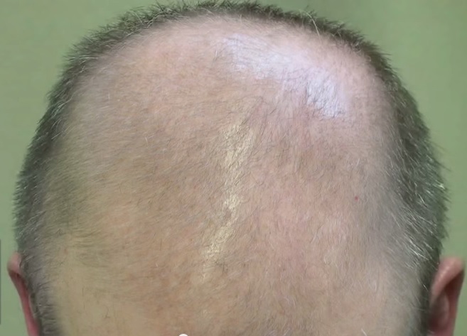 Male Pattern Baldness and DHT