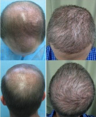 hair restoration surgery sessions