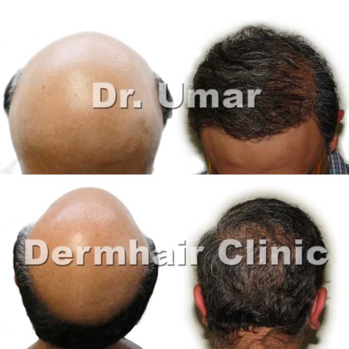  best hair fue restoration surgeon for reversing severe baldness by body hair transplant, Dr Umar and UGraft